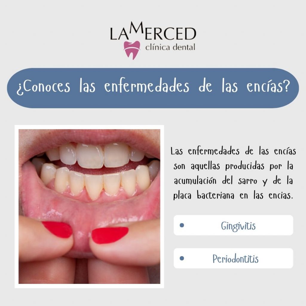 Enfermedades encías